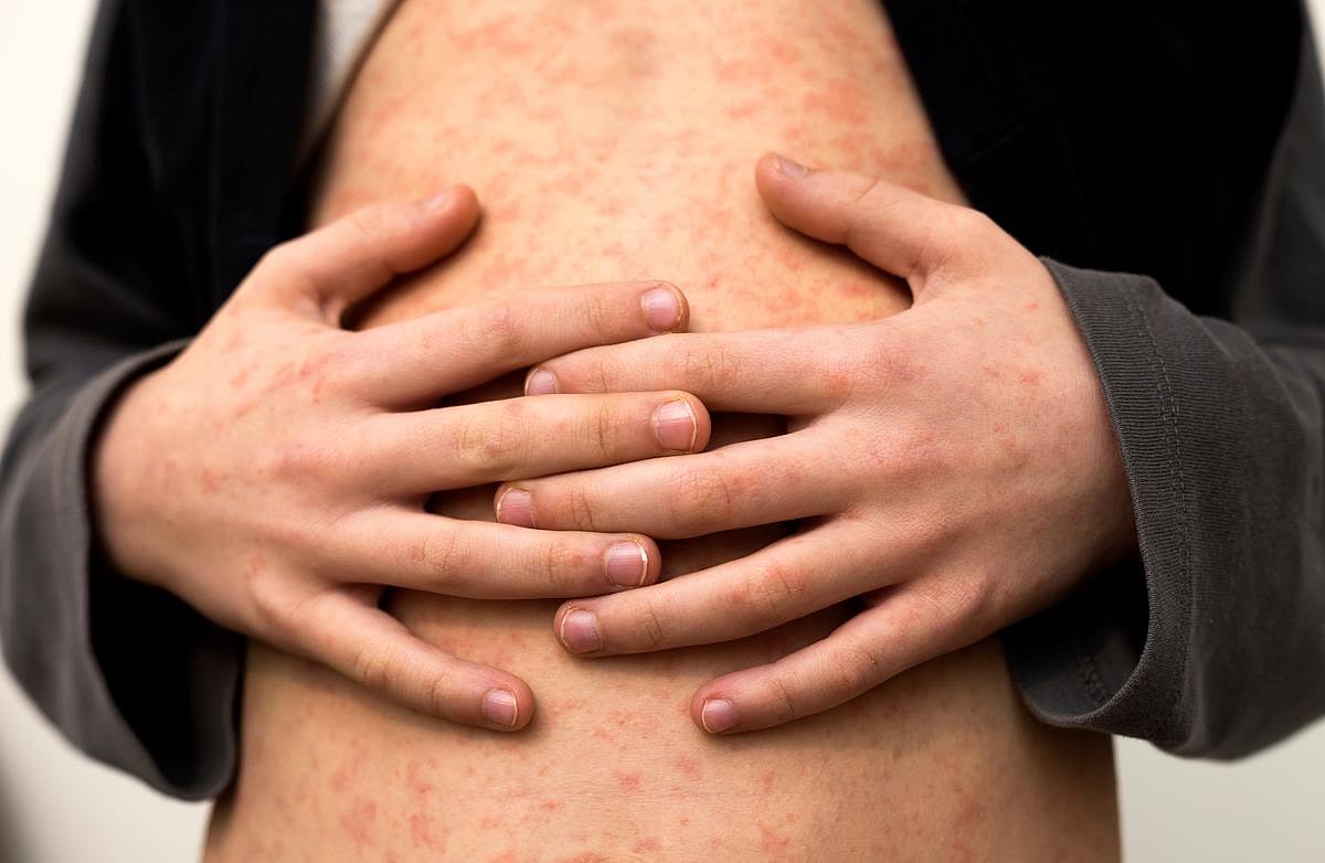 Measles Cases Set 35-Year US Record With Months To Go In 2026