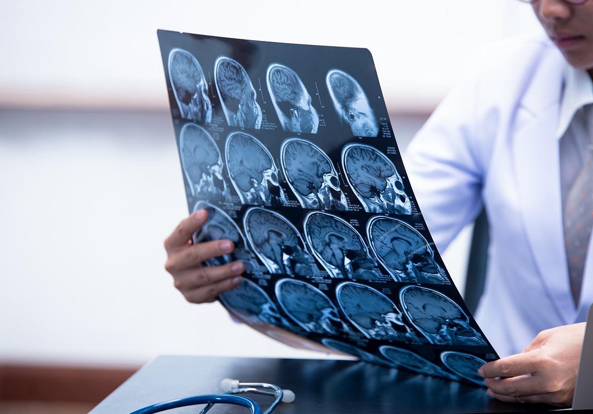 Silent Damage First: Alzheimer's Disease Could Have Two Phases