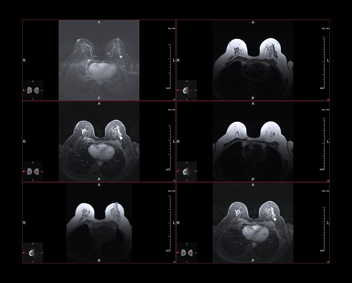 Mammograms May Also Reveal Hidden Heart Disease Risk, Study Finds