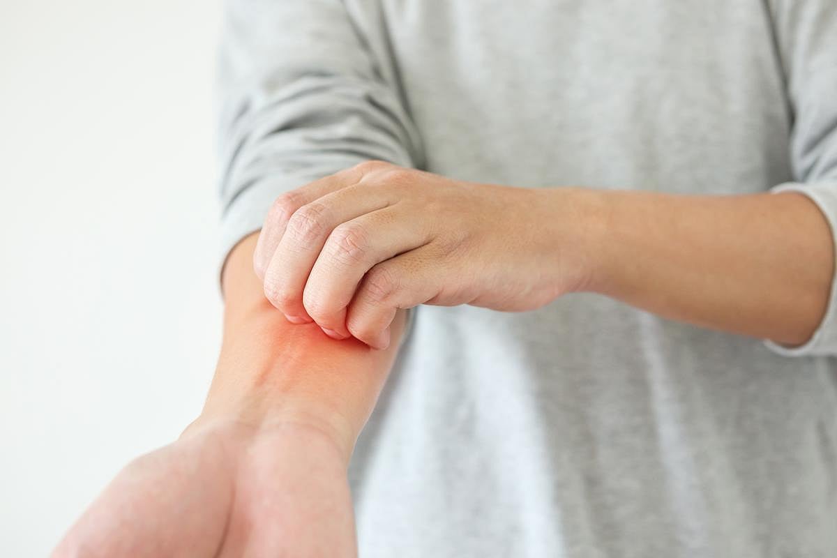 Study Questions Effectiveness of Antihistamines in Easing Eczema