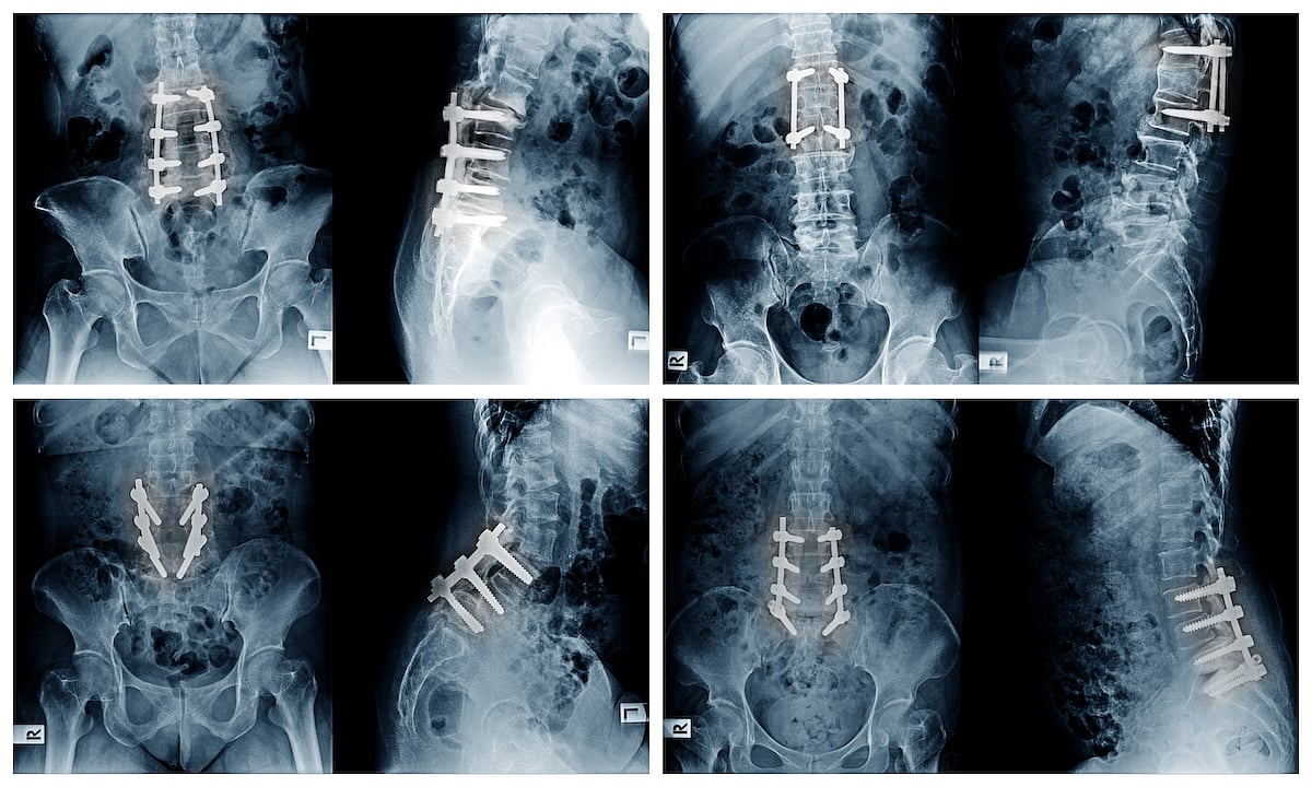 Spinal Fusion Procedures Should Differ Based On Patient's Sex, Experts Argue