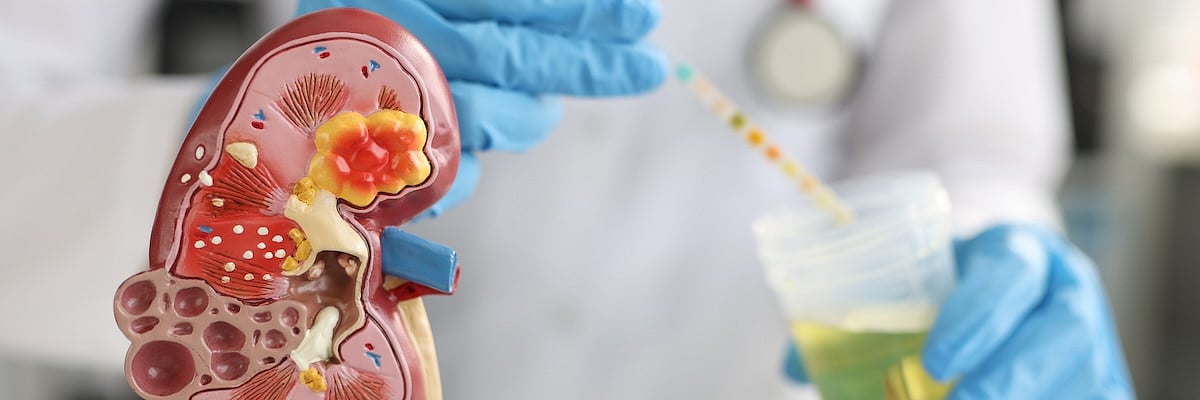 What You Can Do To Prevent Chronic Kidney Disease