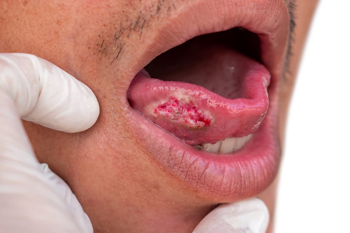New, Highly Accurate Brush Test Can Detect Mouth Cancer Within An Hour