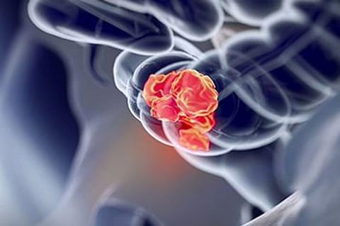 若年性大腸がんが世界的に増加