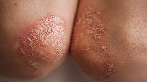 乾癬性関節炎では関節リウマチよりも診断が遅れる