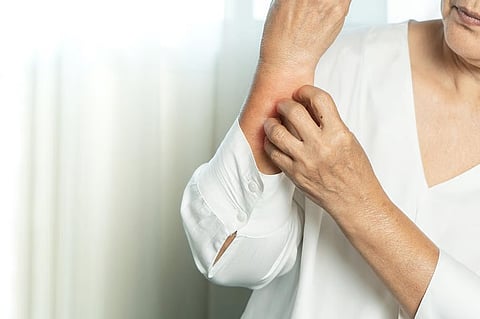 高齢者のアトピー性皮膚炎、世界的に深刻な疾病負荷
