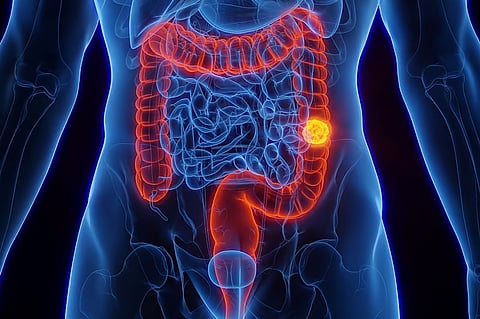 45〜49歳の成人において局所限局期大腸がんの罹患率が上昇
