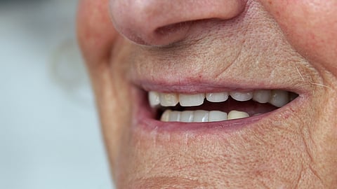 歯を失うと寿命にも影響？80歳女性で“咬合支持”の重要性が明らかに