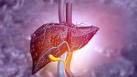 MASLD患者における死亡リスクを最も高める3つの心血管代謝リスク因子を特定