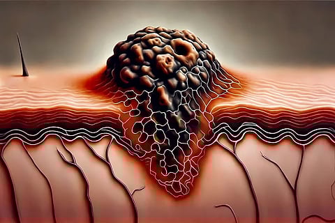 ペムブロリズマブの術前投与が線維形成性黒色腫の生存率を改善