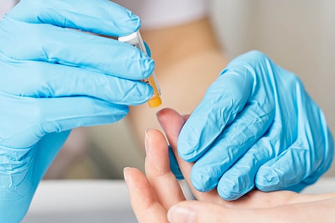 膵臓がんの発症リスク、血糖と生活習慣で予測可能か