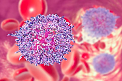 慢性リンパ性白血病患者では皮膚がんリスクが上昇
