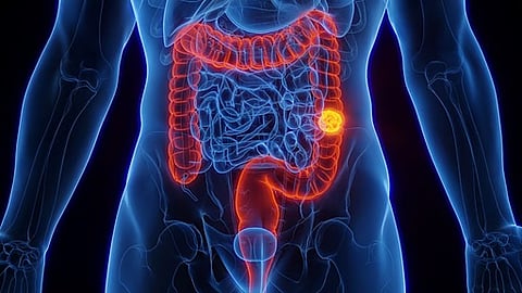 腺腫の既往歴を持つ高齢者における大腸がんリスクと大腸がん以外による死亡リスク