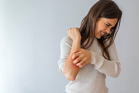 アトピー性皮膚炎は睡眠障害および記憶障害と関連