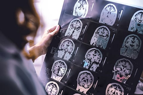 AIを用いたMRI解析で従来検出困難だった多発性硬化症の皮質病変を検出