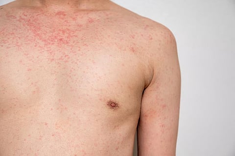 高用量ビタミンDは放射線療法や化学療法による皮膚障害を速やかに緩和