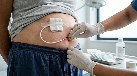 低用量で開始する腹膜透析では低タンパク質食が有利な可能性