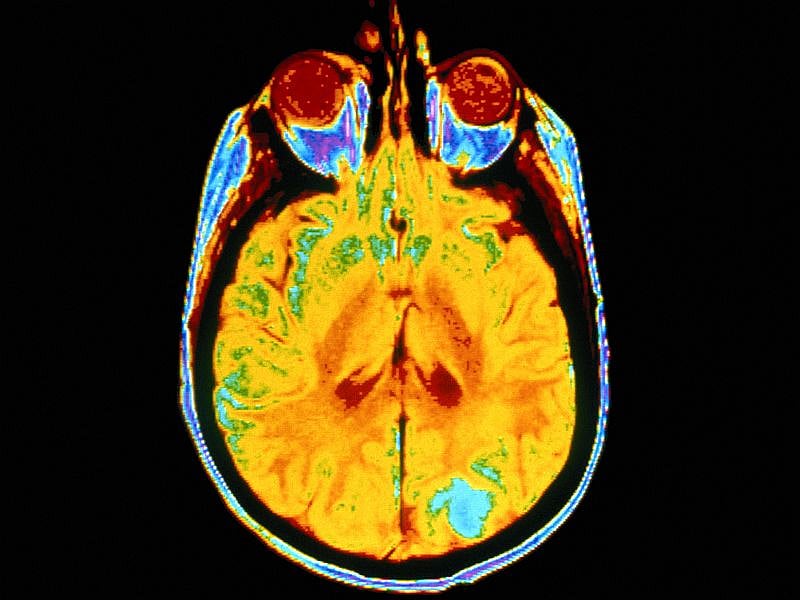 Nicotine Study Shows Mind's Power When It Comes to Drugs