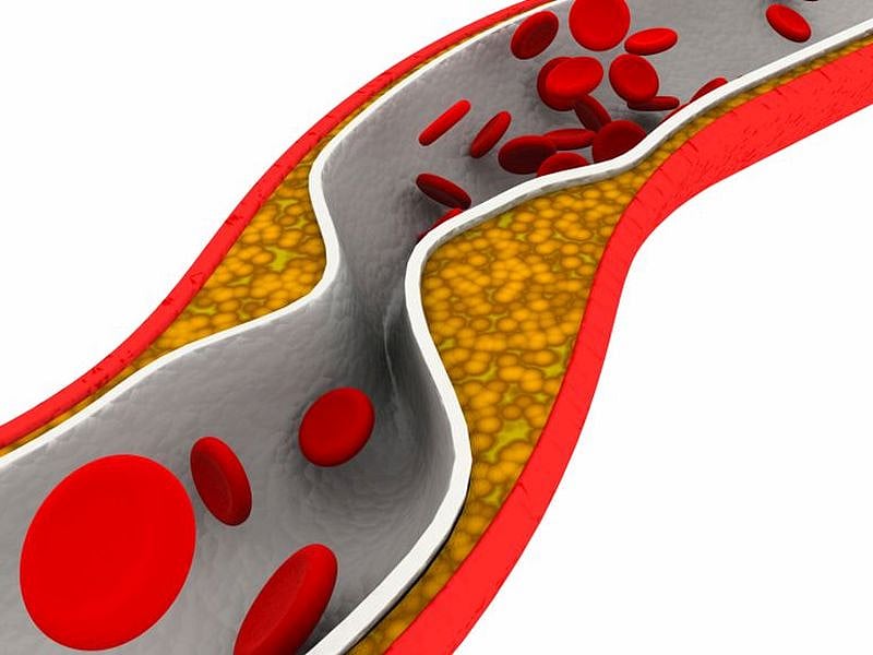 High Blood Triglycerides Could Help Ward Off Dementia