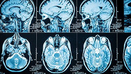 MRNA Vaccine Fights Deadly Brain Tumor in Small Trial