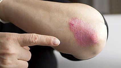Mouse Study Yields Clues to Why Psoriasis Worsens