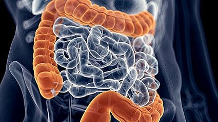Drug That Treats Cocaine Addiction May Curb Colon Cancer