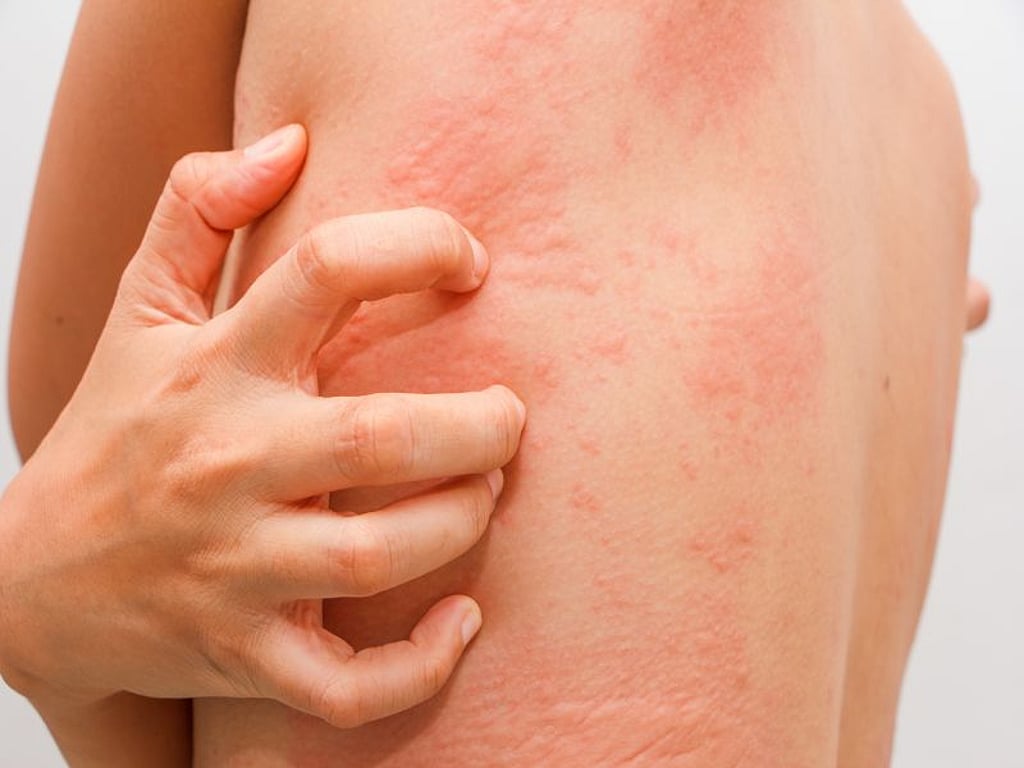 Stress Rash Back Stress Rash: What It Looks Like, Symptoms & Treatment