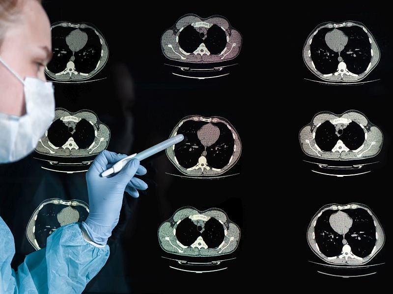 CT Screening Greatly Boosts Lung Cancer Survival: Study