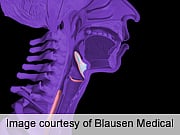 Matted Lymph Nodes ID Poor Oropharyngeal SCC Prognosis