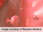 Study Supports Longer Scope Intervals Post-Polypectomy