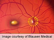 Avastin and Lucentis Equally Improve Visual Acuity in AMD