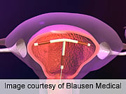 Risk of Pelvic Inflammatory Disease With IUDs Is Low