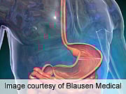 Radiofrequency Ablation Cuts Barrett's Esophagus Progression