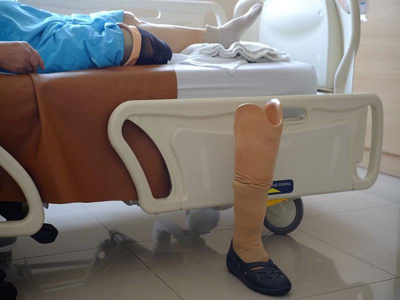 First Treatment Found for Rare Disease That Can Lead to Amputation