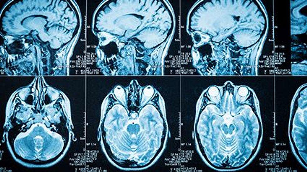 Iron Gathers in Brain After Concussions