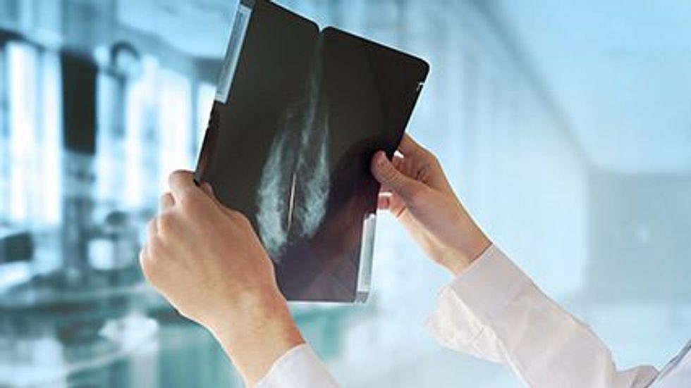 AI Might Help Spot Breast Cancer's Spread Without Biopsy