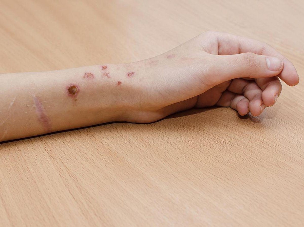 Teen Social Media Posts About Cutting, Other SelfHarm Are Soaring