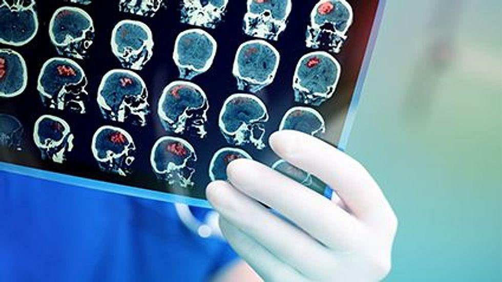 Fat Hiding Around Organs Could Raise Odds for Alzheimer's