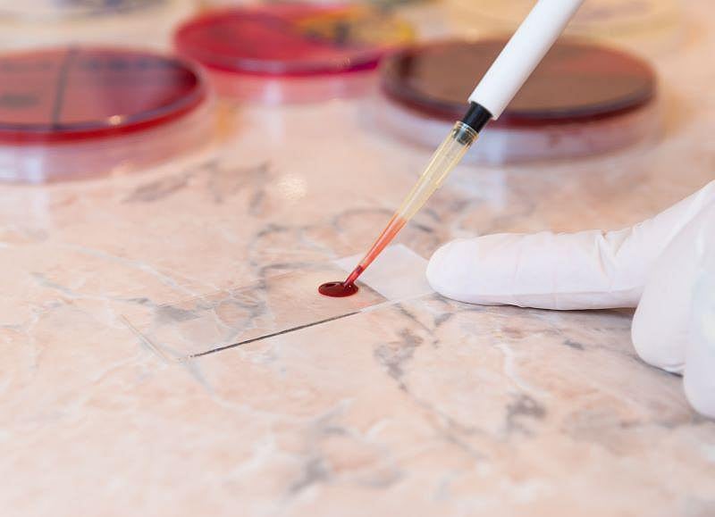Blood Test Could Speed Diagnosis of Bipolar Disorder