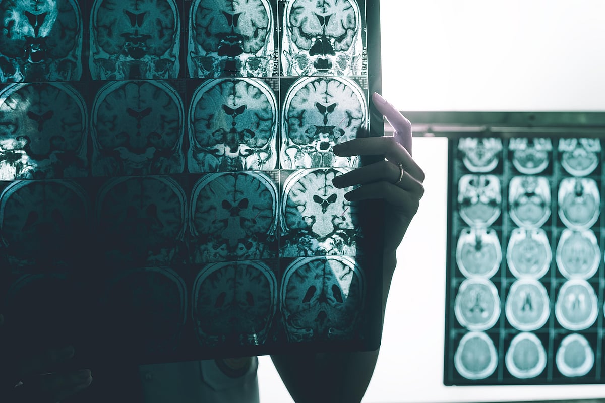 Brain Plaques, Not Just Age, Point to Who'll Get Alzheimer's Disease