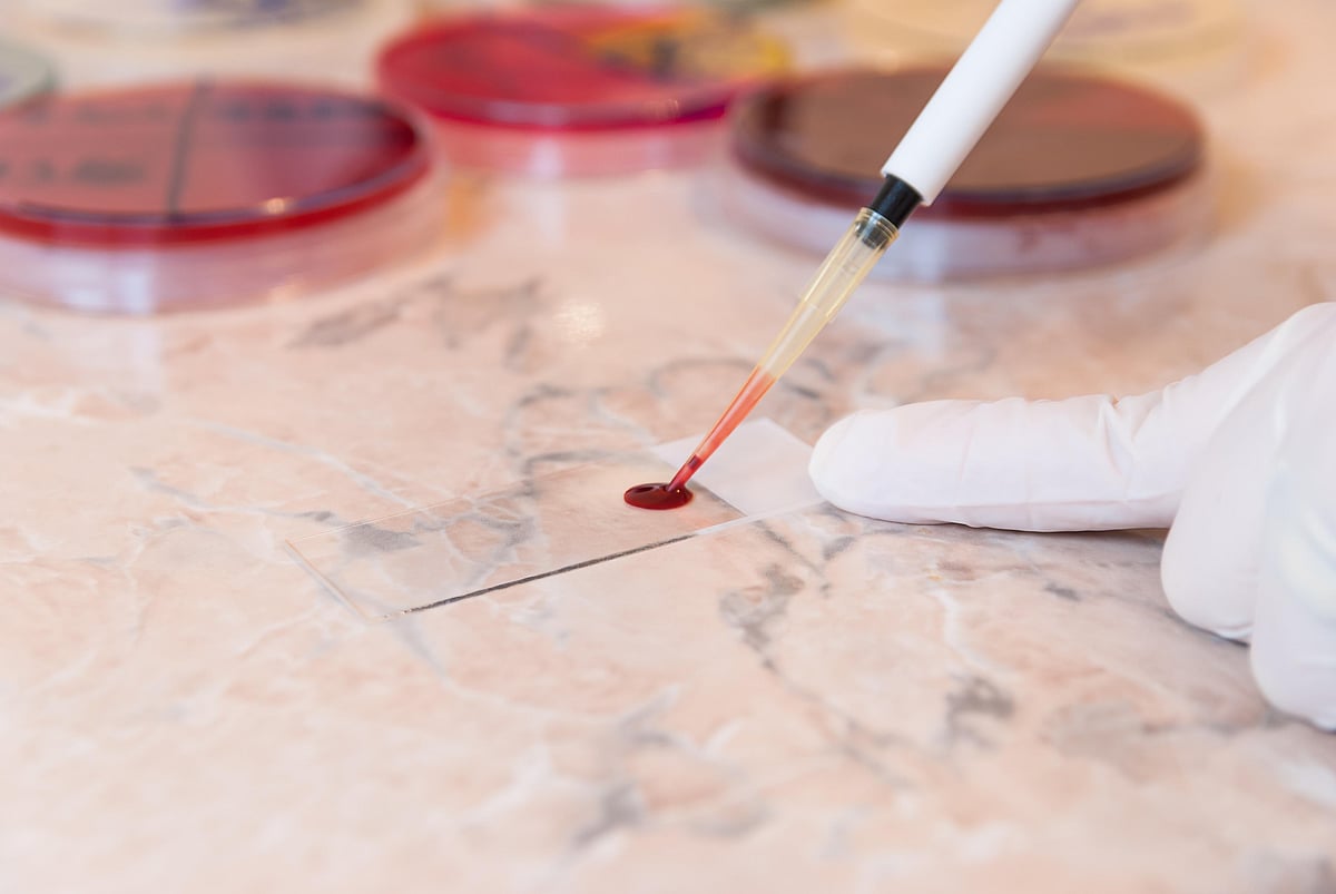 Blood Test to Predict Schizophrenia Shows Promise
