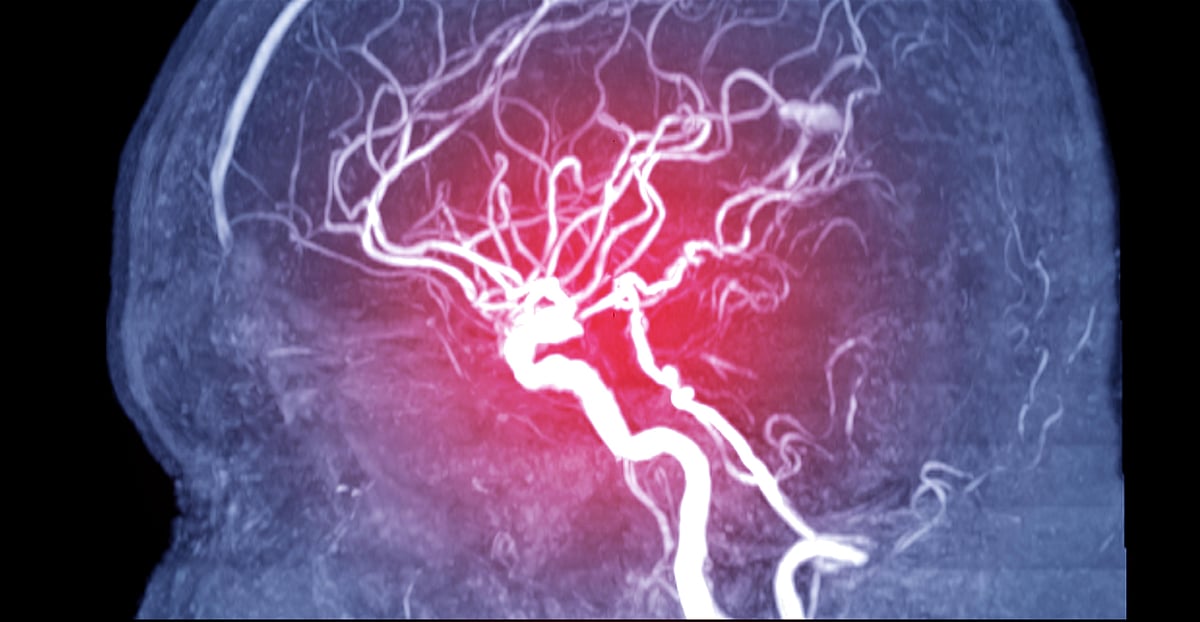 Lab-Grown Brain Blood Vessels Show New Ways to Prevent Stroke, Dementia