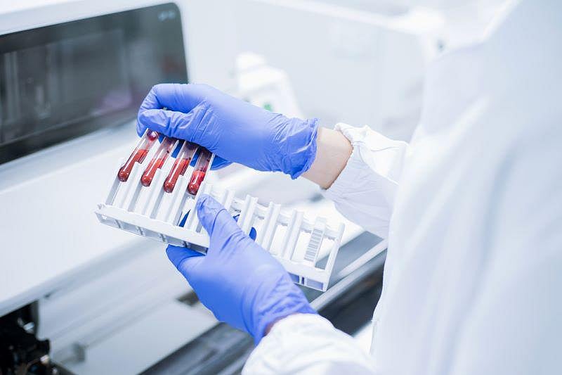 Blood Test Spots Early Pancreatic Cancers With 97% Accuracy