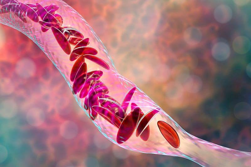 COVID Can Threaten Sickle Cell Patients, But Too Few Are Vaccinated