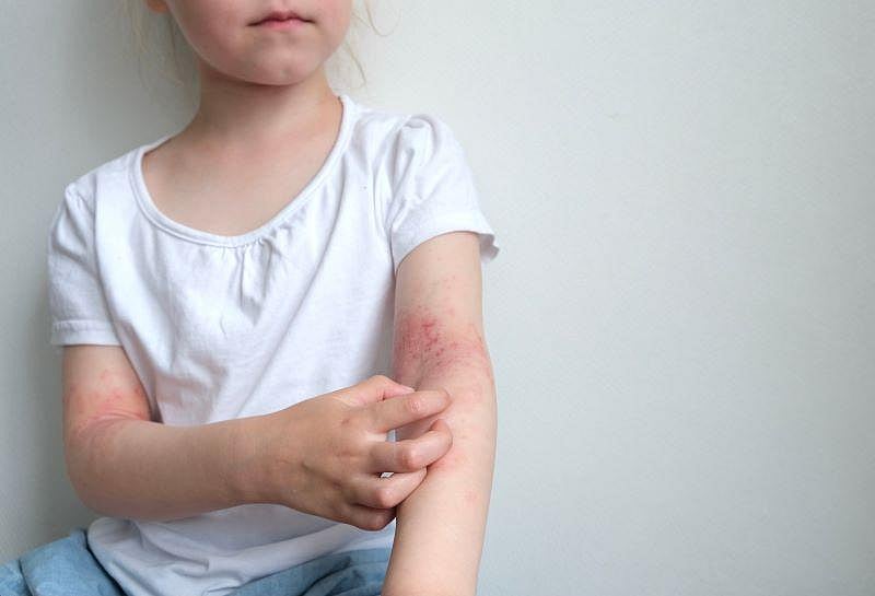 Parents' Vaping Might Help Spur Eczema in Kids