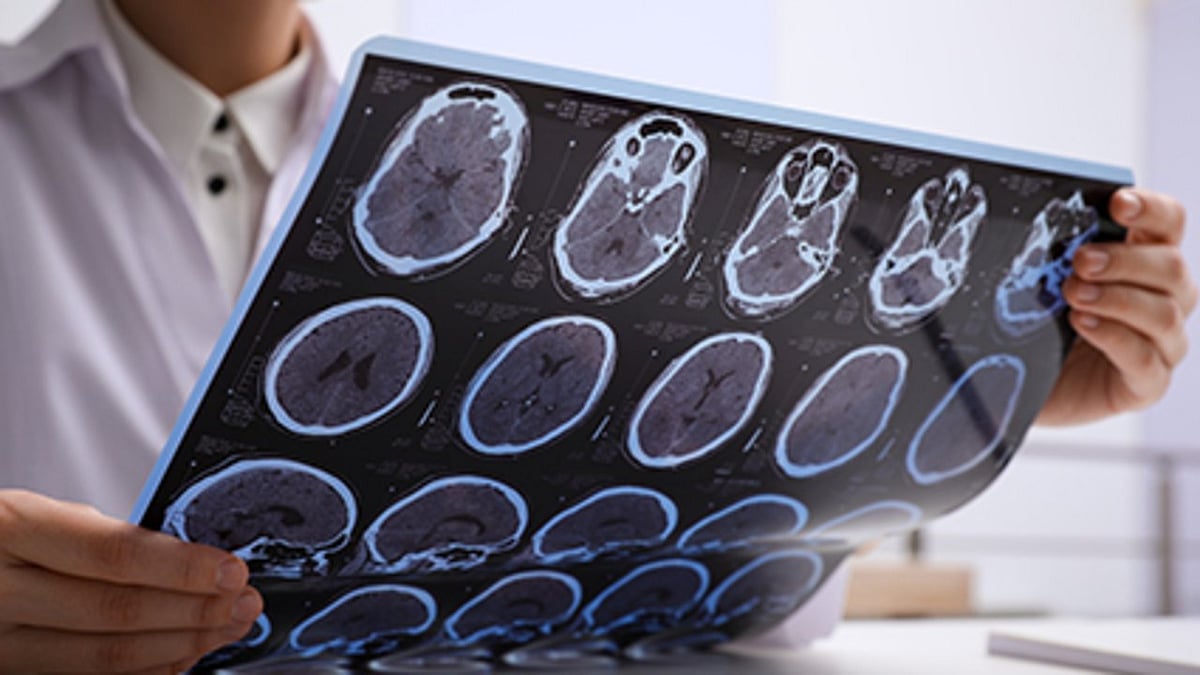 Black Patients Wait Longer Than Whites for Alzheimer's Diagnosis