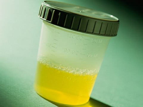 尿pH測定が糖尿病の高リスク者発見に有用 低値で耐糖能異常リスク上昇、愛媛大
