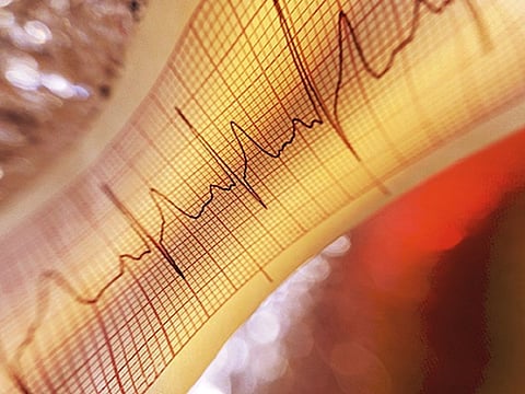 致死的な不整脈治療に放射線療法が有望