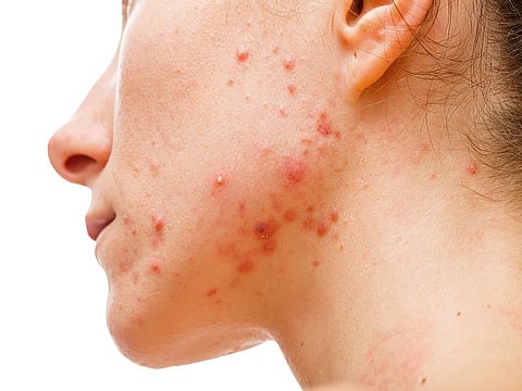 Acne skin because the disorders of sebaceous glands productions