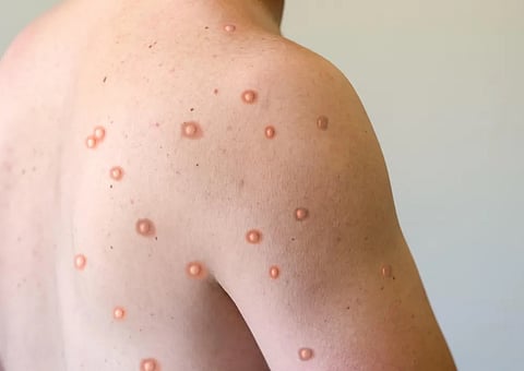 米国でのサル痘の現状とは――CDCの報告